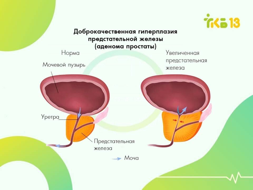 УЗИ предстательной железы трансабдоминально с определением остаточной мочи в СПб.